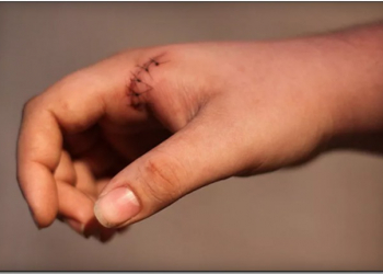 醫療科技新境界，當縫線有了智慧更能監測傷口復原 - 電腦王阿達