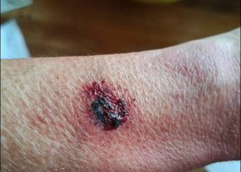 美國使用者穿戴 Fitbit Flex 2 運動手環過程中突然爆炸！造成二級燒傷 - 電腦王阿達