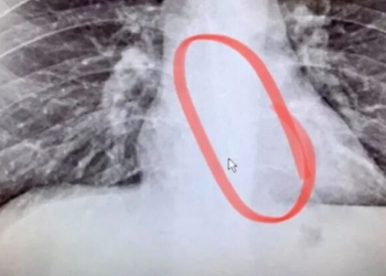 國外有人睡覺時不小心吞下自己的 AirPods，習慣戴耳機入睡的人請小心 - 電腦王阿達