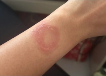 印度用戶控訴 Apple Watch 灼傷手腕，維權半年無果怒批客服「踢皮球」