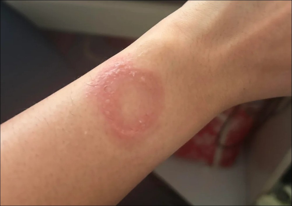 印度用戶控訴 Apple Watch 灼傷手腕,維權半年無果怒批客服「踢皮球」 - 電腦王阿達 印度用戶控訴 Apple Watch 灼傷手腕,維權半年無果怒批客服「踢皮球」 - 電腦王阿達