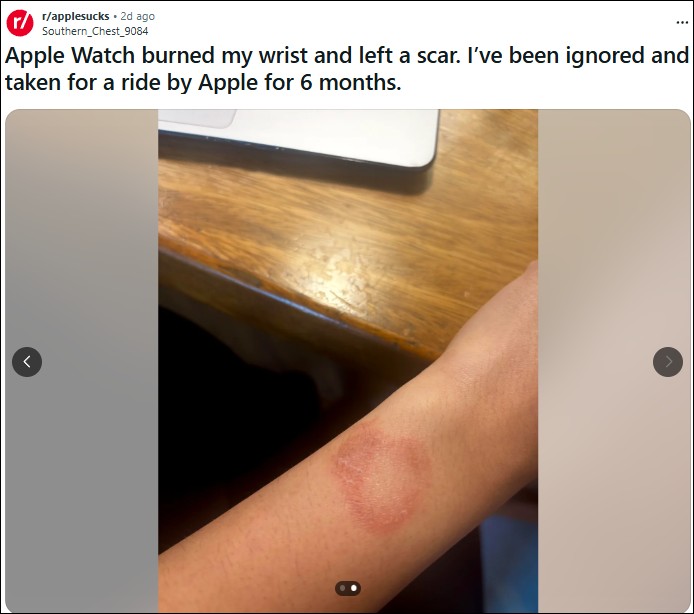 印度用戶控訴 Apple Watch 灼傷手腕,維權半年無果怒批客服「踢皮球」 - 電腦王阿達 印度用戶控訴 Apple Watch 灼傷手腕,維權半年無果怒批客服「踢皮球」 - 電腦王阿達